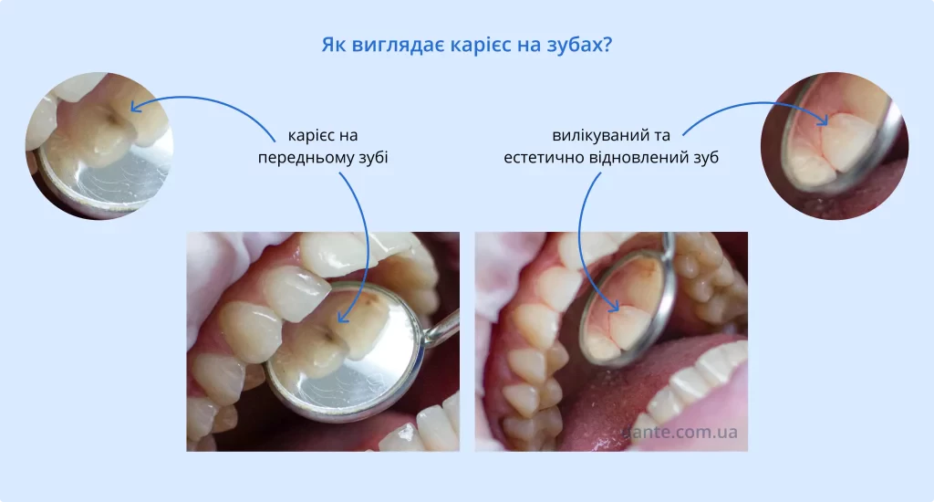 Як виглядає карієс на зубах