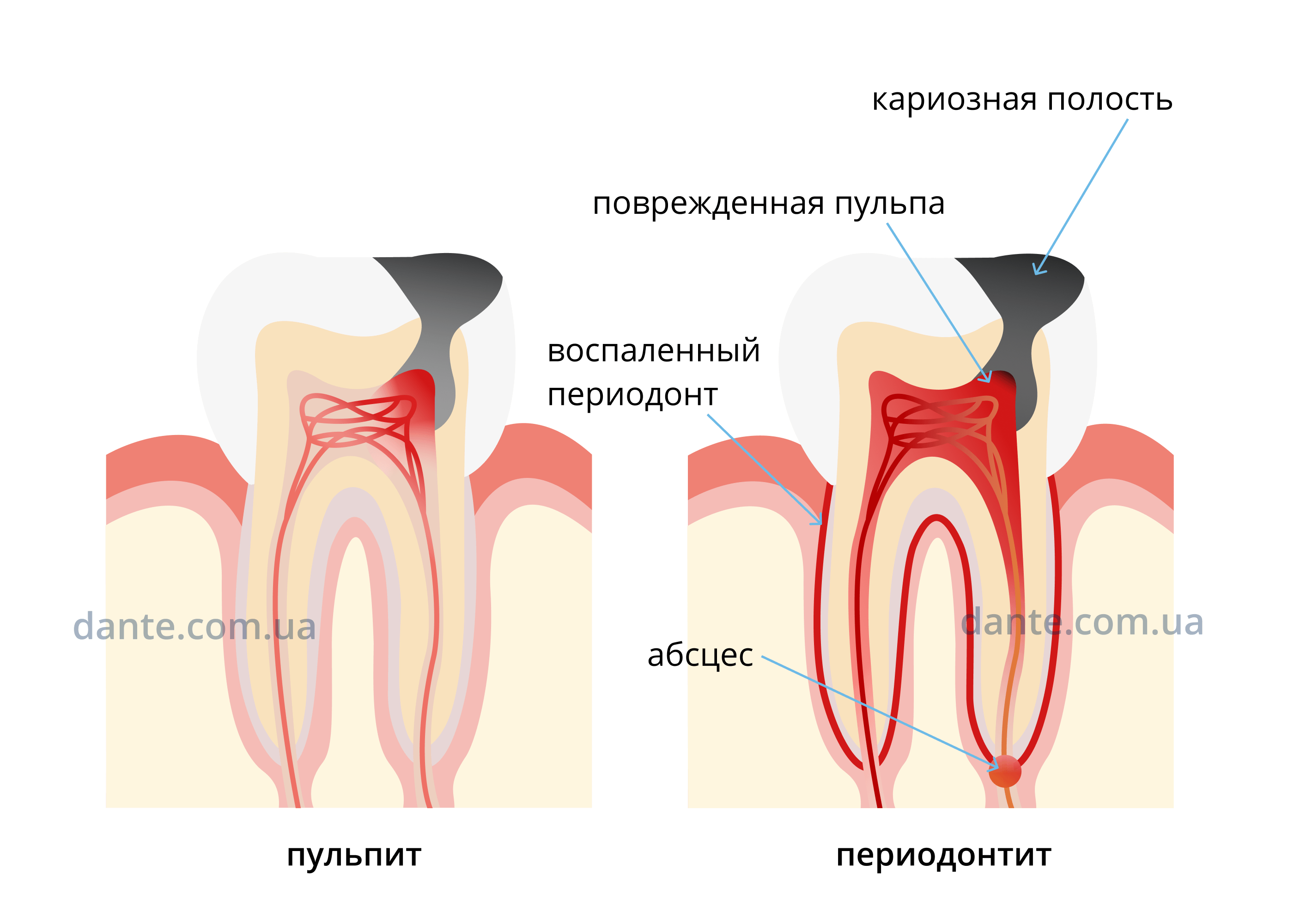 Пульпит: причины, формы и профилактика заболевания | D.Ante