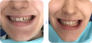 *трема: до і після лікування в D.Ante