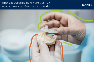 Особенности протезирования на 4-х имплантах