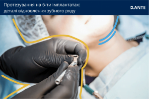 Протезування на 6-ти імплантах | D.Ante