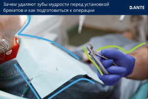 Удаление зубов мудрости перед установкой брекетов