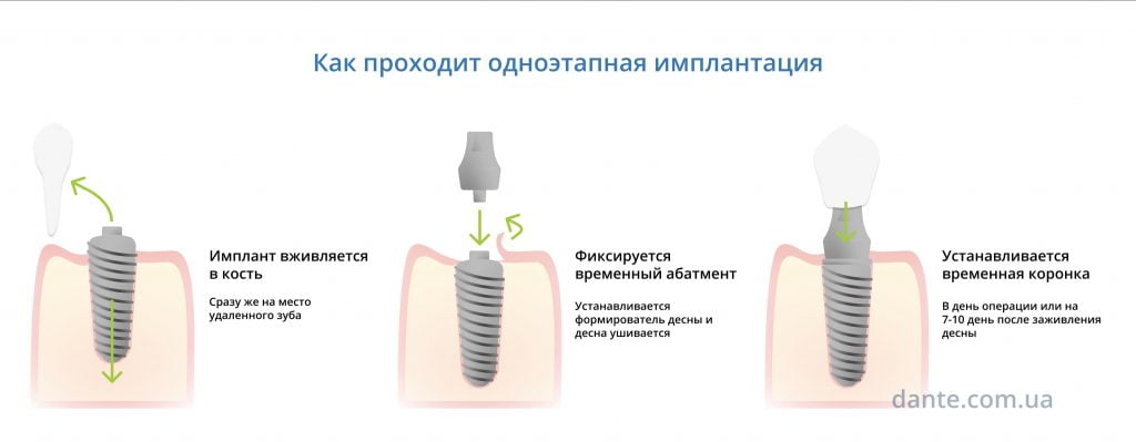 этапы одноэтапной имплантации