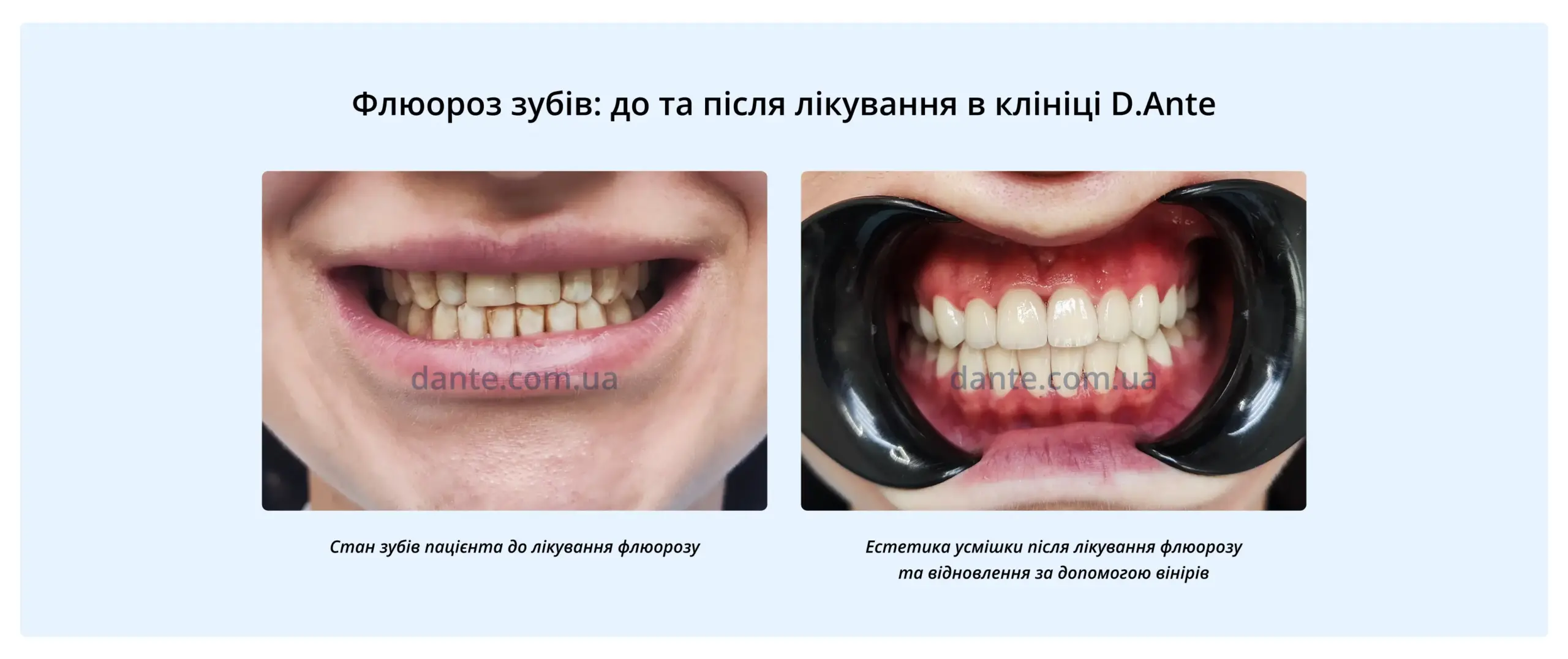 Флюороз до та після лікування. Відновлення естетики за допомогою вінірів