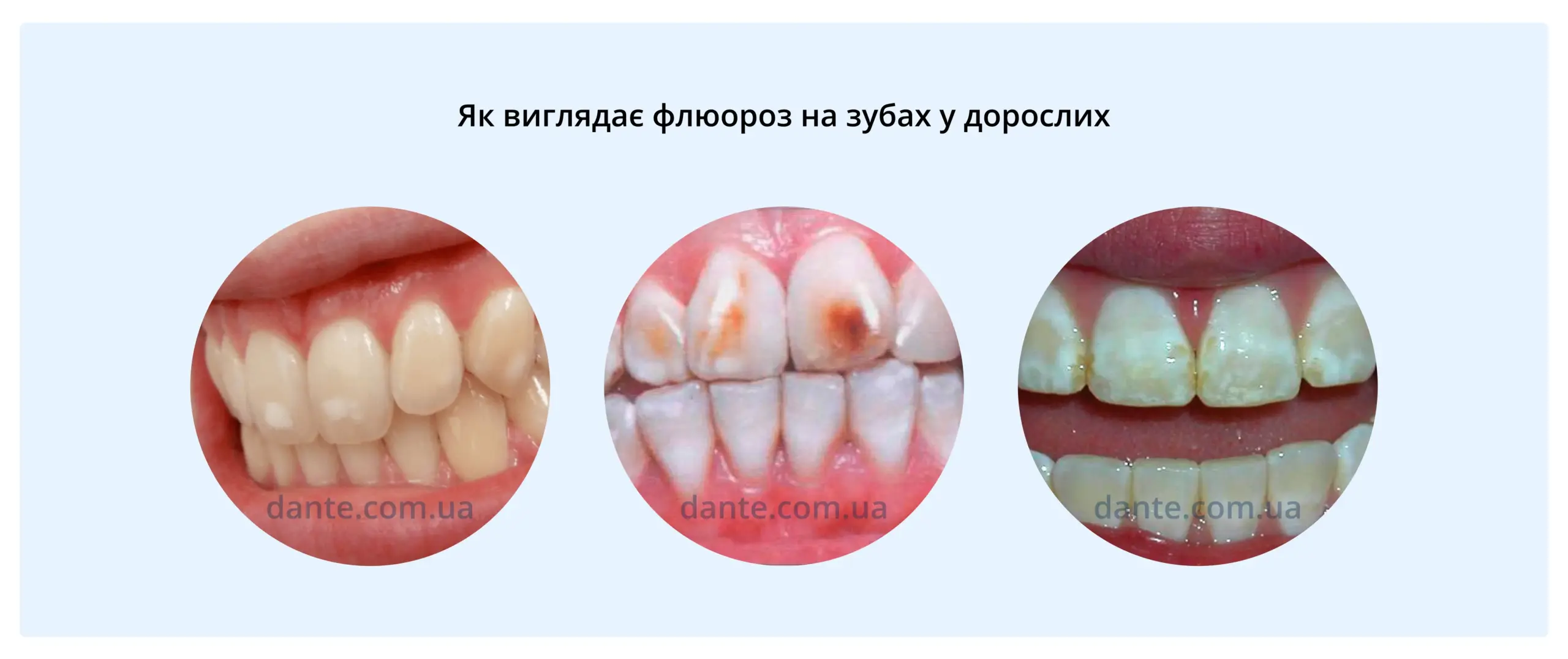 Як може виглядати флюороз на зубах у дорослих: флюороз фото