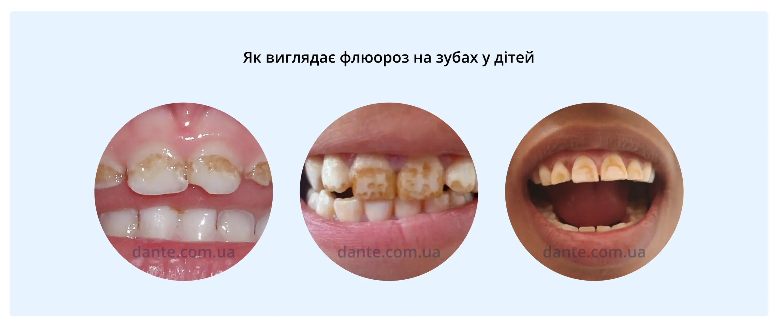 Флюороз у дітей фото: як виглядає флюороз у дітей