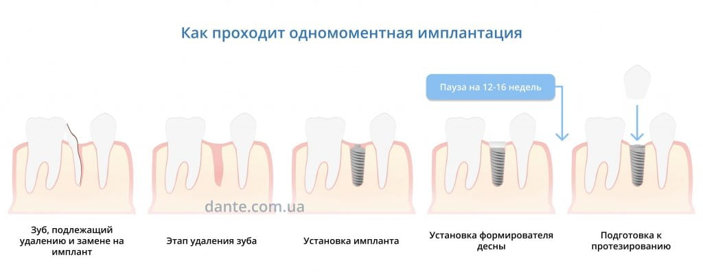 как проводят одномоментную имплантацию