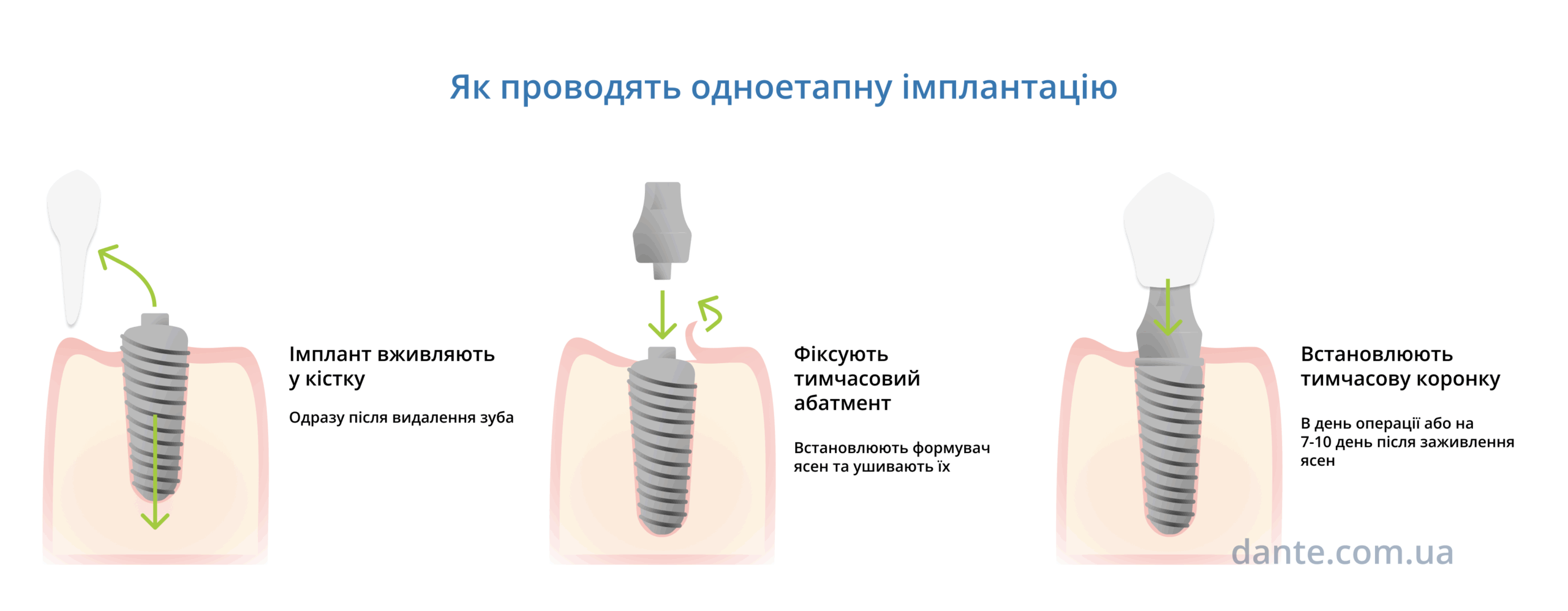 Одноетапна імплантація. Як проводять процедуру — послідовність етапів