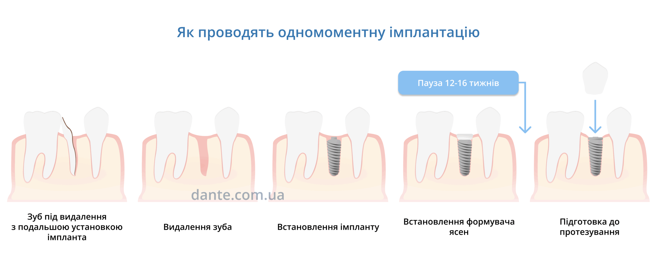 Одномоментна імплантація. Як проводять процедуру — послідовність етапів