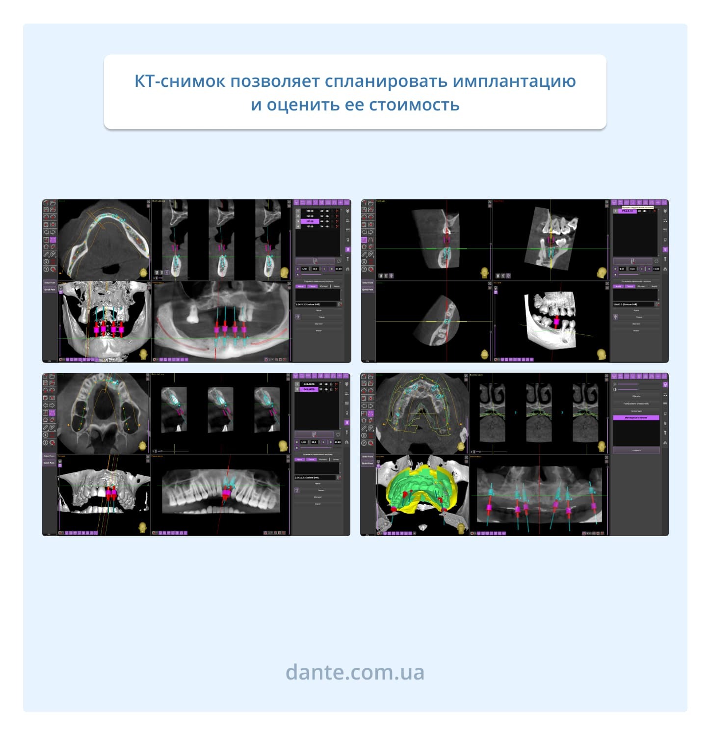 Определение цены импланта на основе КТ