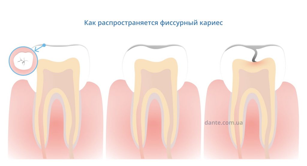 Как распространяется фиссурный кариес