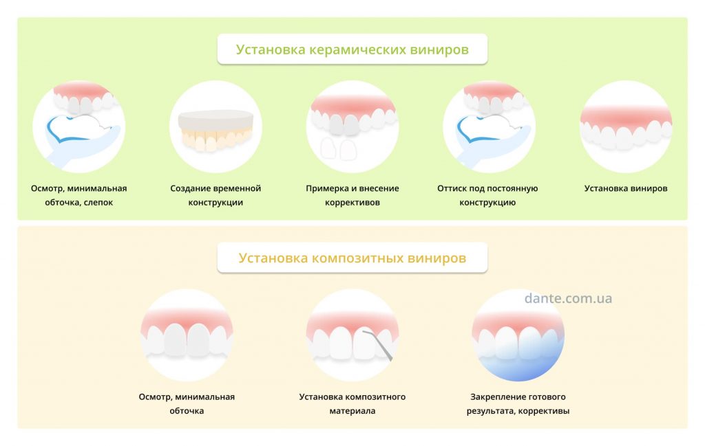 Как устанавливают виниры на зубы