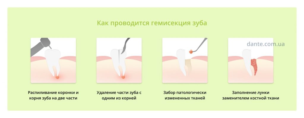 гемисекция зуба