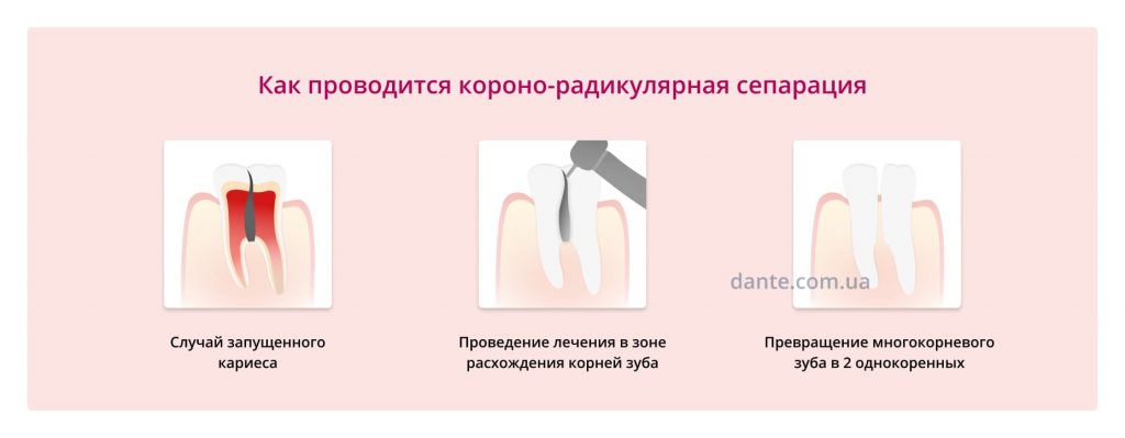 Зубосохраняющая операция. Коронорадикулярная сепарация методика. Коронково-радикулярная сепарация (Разделение) коронки зуба. Коронорадикулярная сепарация зуба. Короно-радикулярной сепарации.