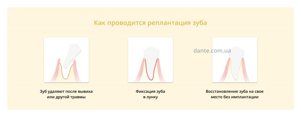 реплантация зуба