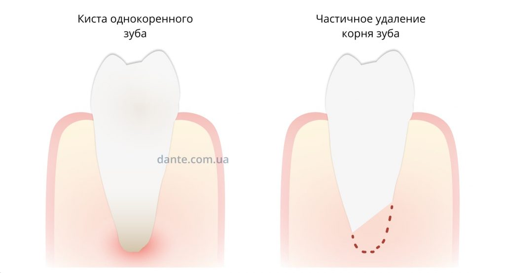 Что такое резекция корня зуба