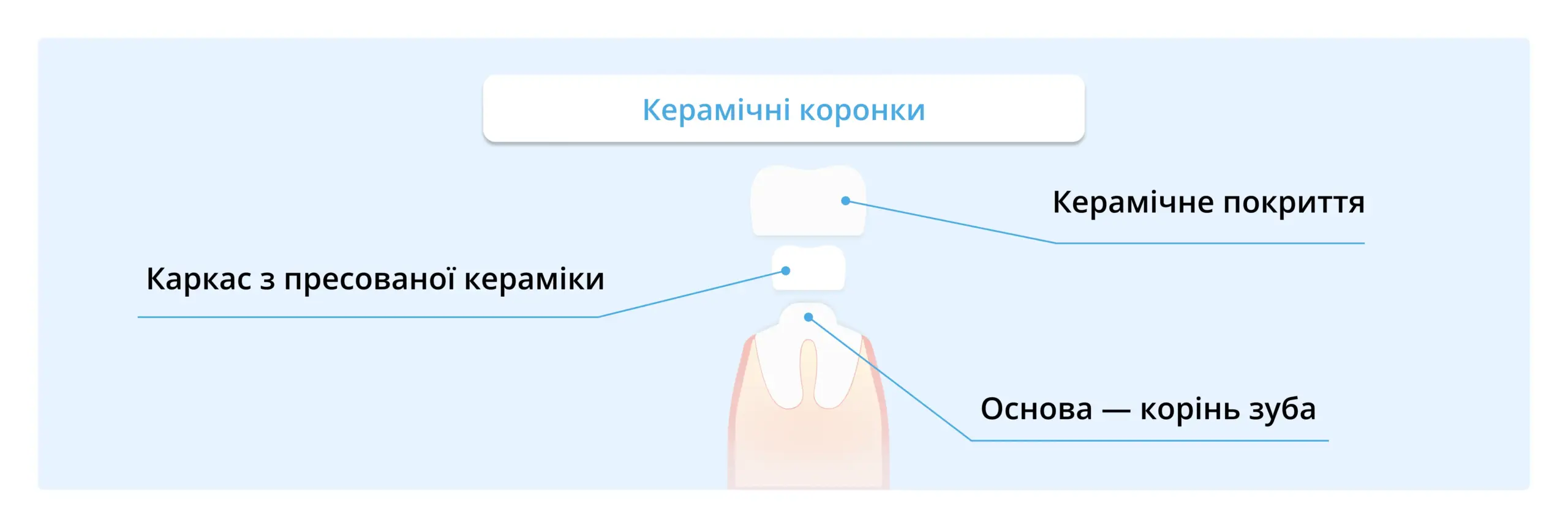 З чого виготовляють керамічні коронки: каркас та покриття