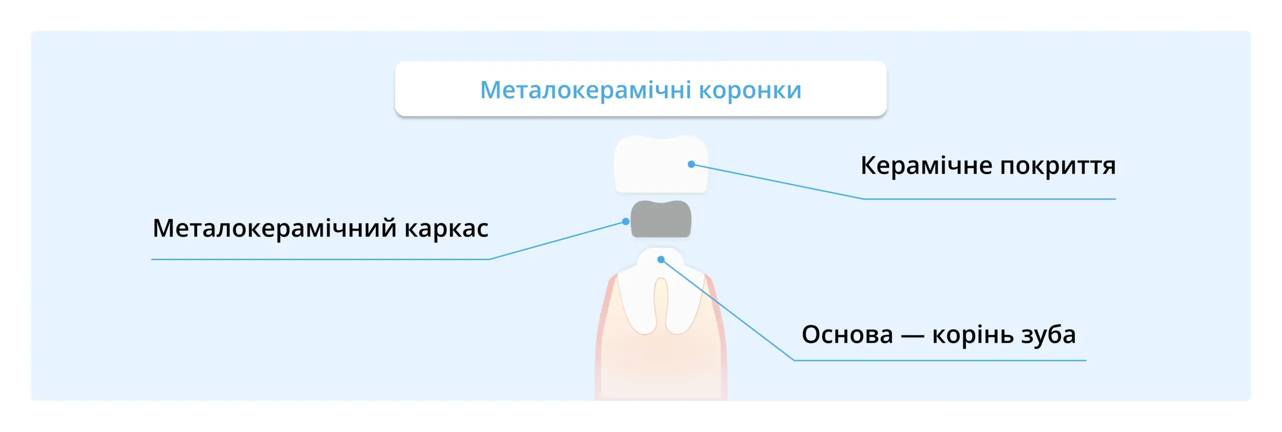 З чого виготовляють металокерамічні коронки: каркас та покриття