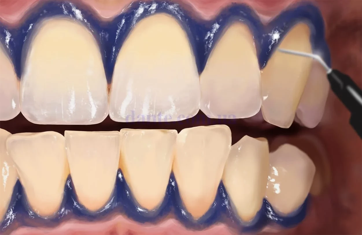 Відбілювання зубів