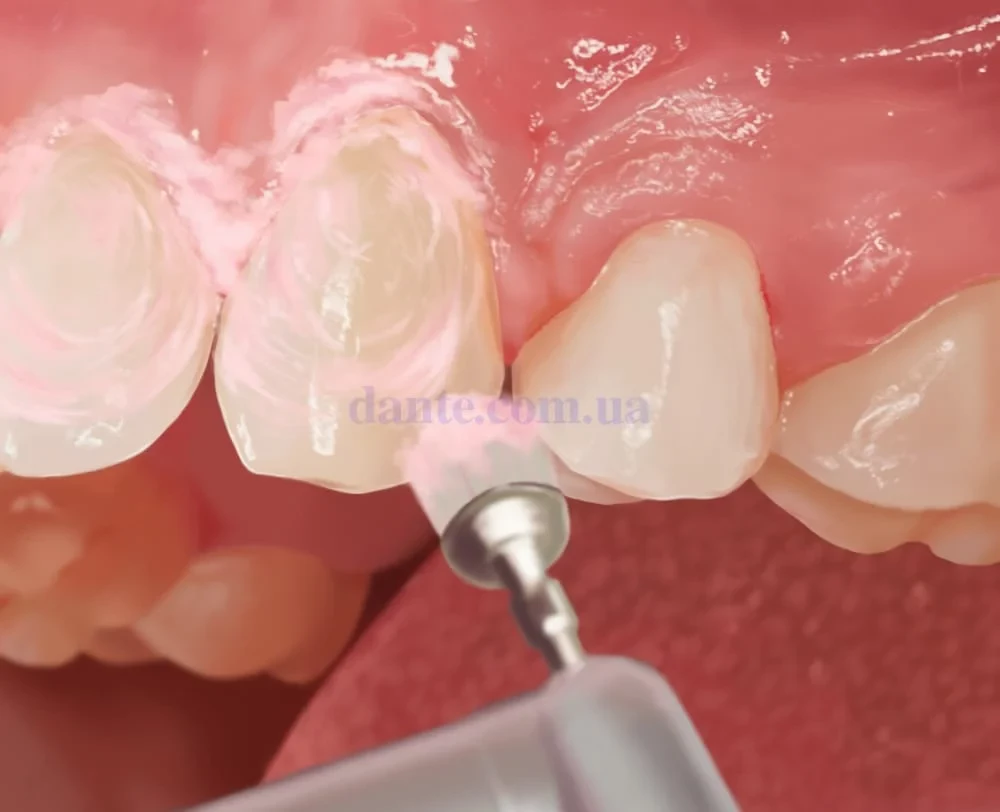 Профессиональная чистка зубов