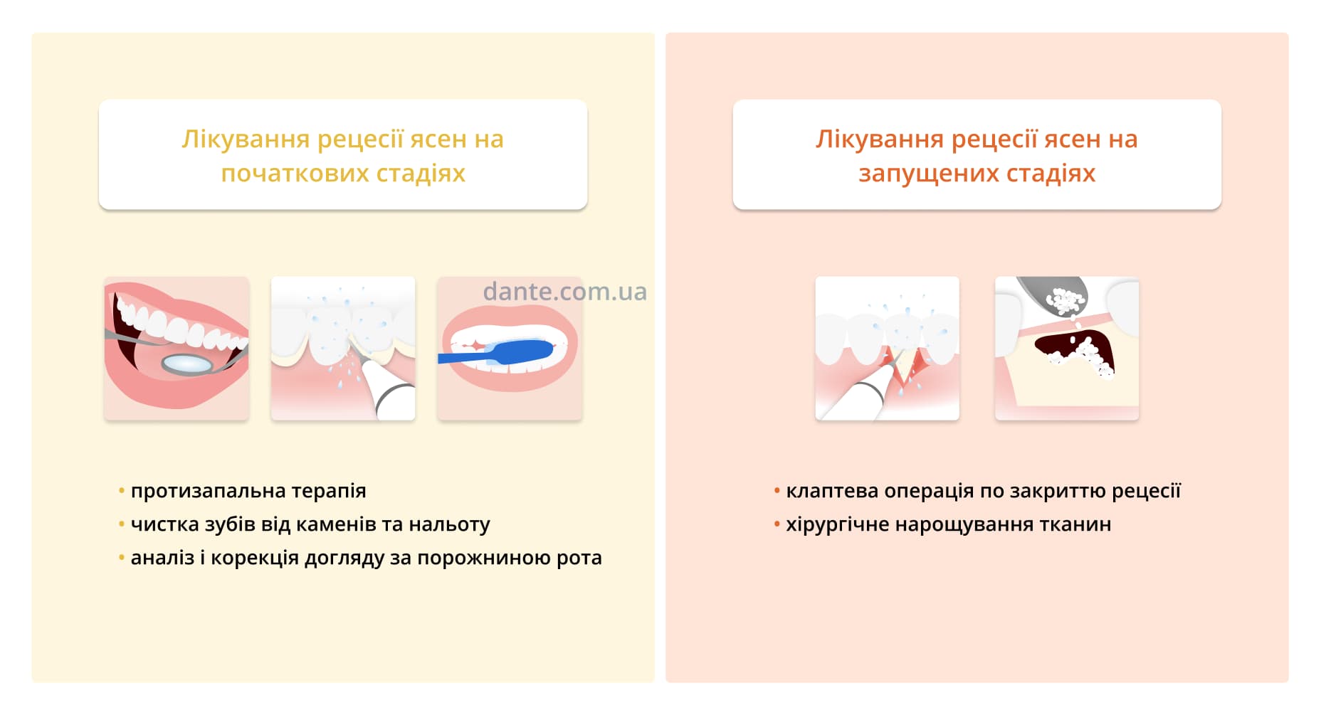 як лікують рецесію ясен в залежності від стадії патології
