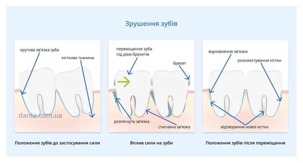 зрушення зубів з брекетами