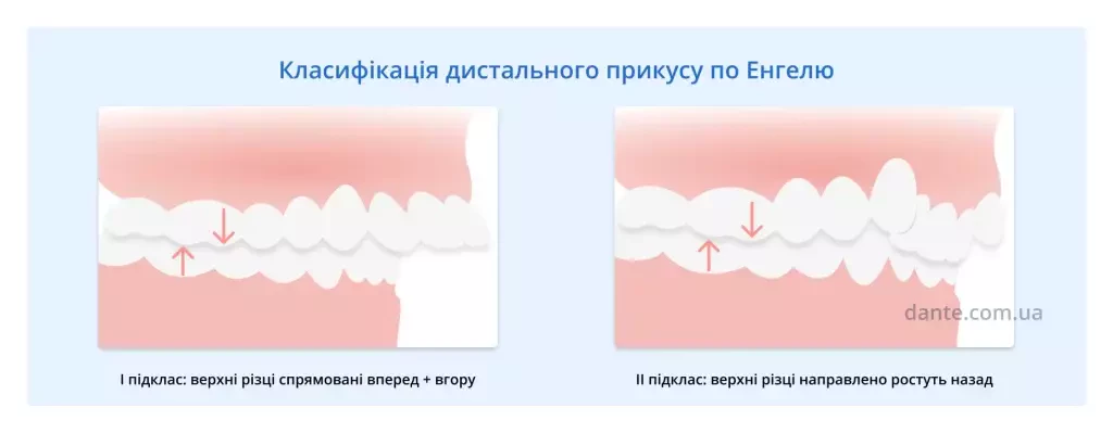 класифікація дистального прикусу