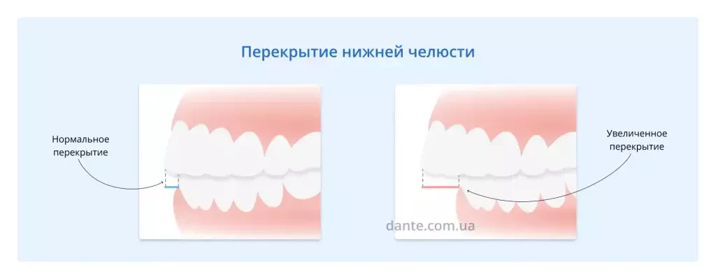 дистальный прикус: перекрытие нижней челюсти