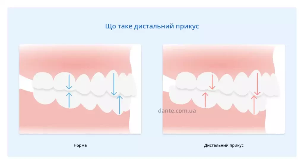що таке дистальний прикус