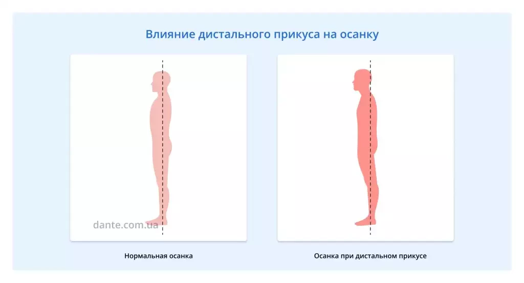 дистальный прикус и осанка