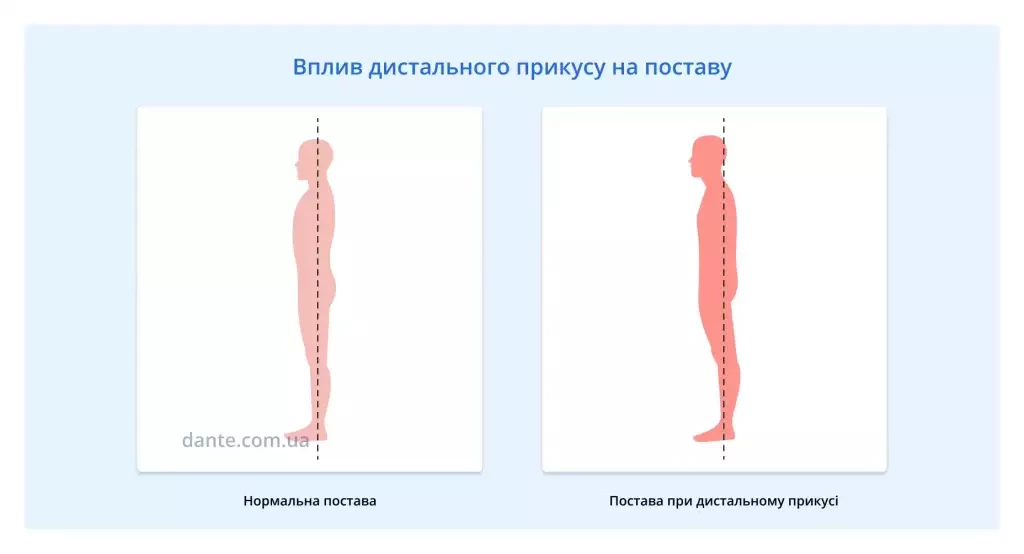 дистальний прикус та постава