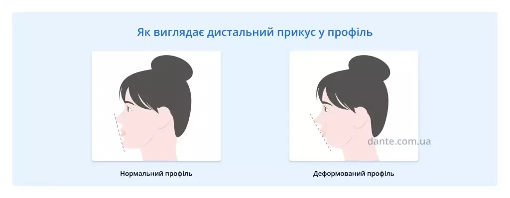 як виглядає дистальний прикус