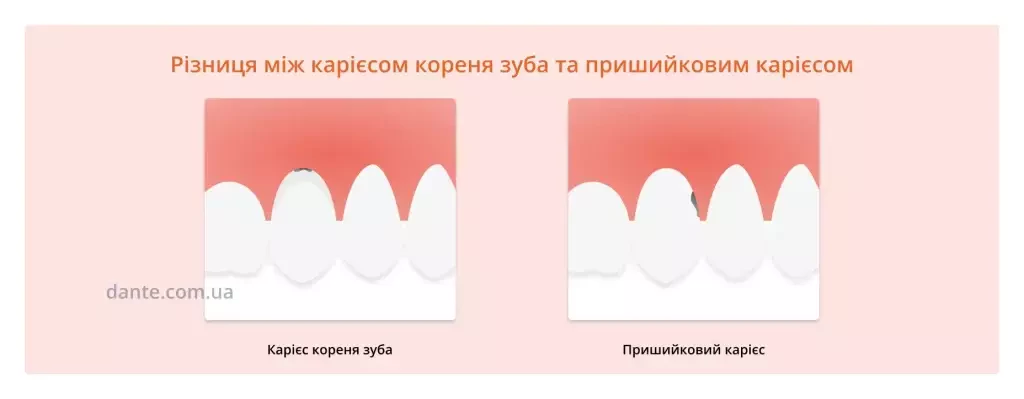 Карієс корня зуба vs Пришийковий карієс