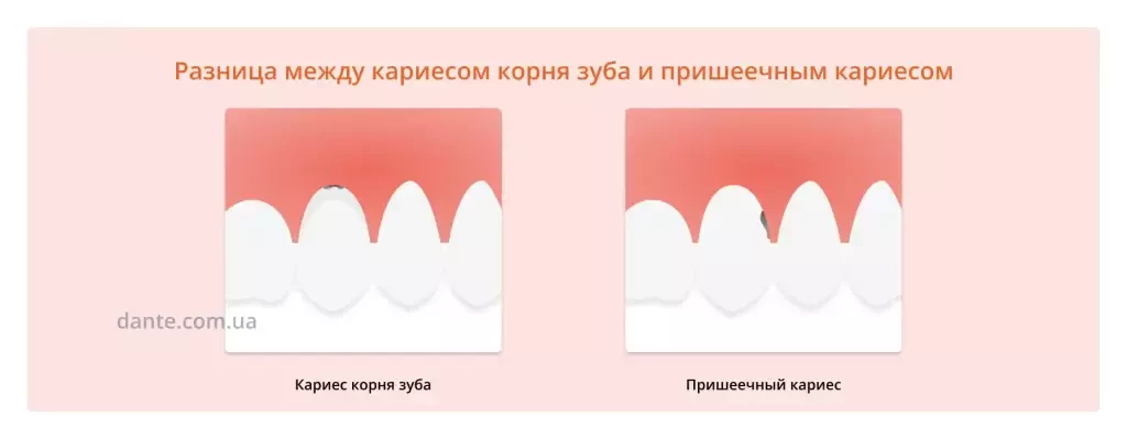 Кариес корня зуба vs Пришеечный кариес
