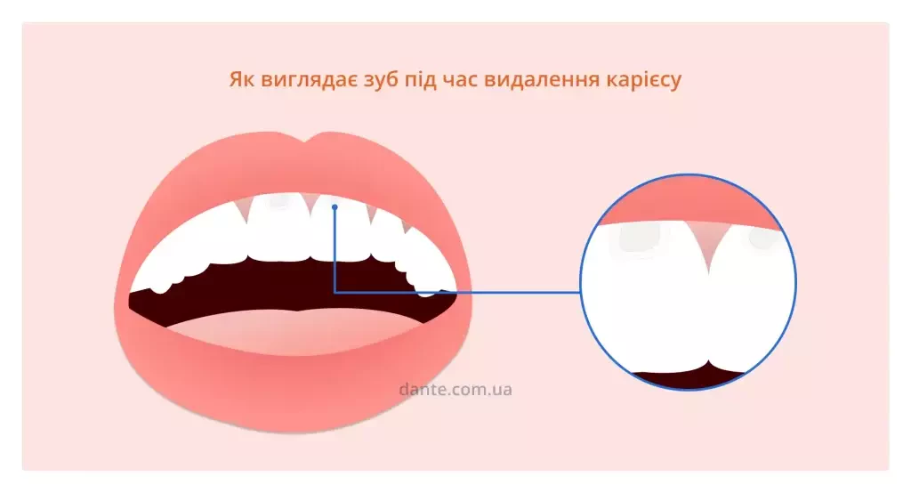запущений пришийковий карієс