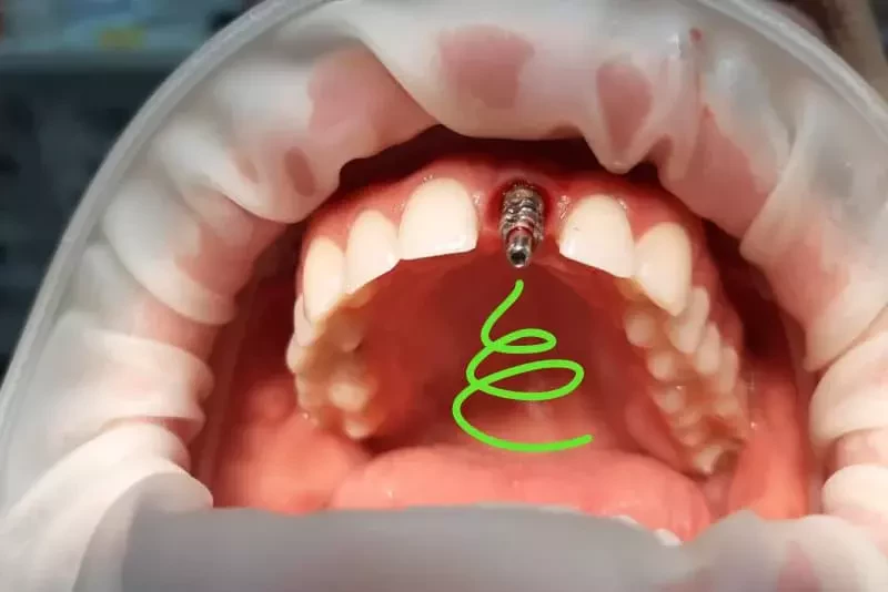 Имплантация