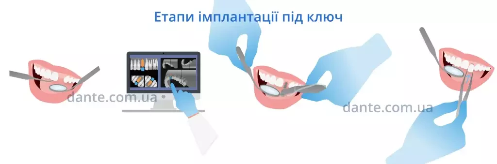 етапи імплантації під ключ