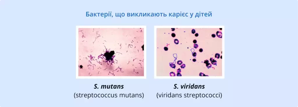 Бактерії, що викликають карієс у дітей | Дитяча стоматологія | Стоматологія D.Ante