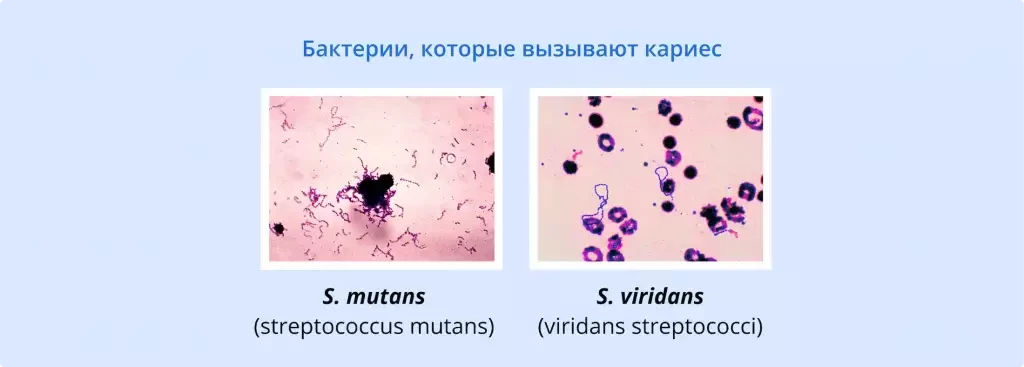 Бактерии, которые вызывают кариес | Детская стоматология | Стоматология D.Ante