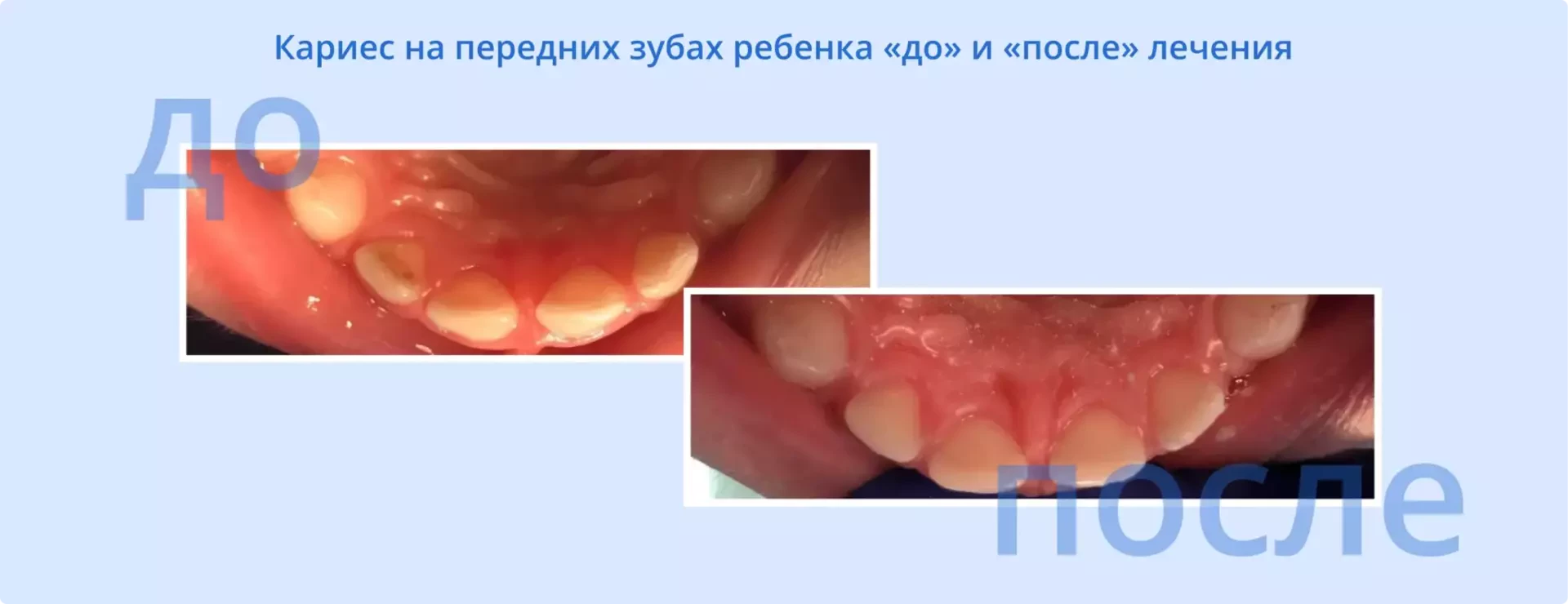 Кариес передних зубов у детей фото | Стоматологическая клиника D.Ante Кариес передних зубов у детей фото | Стоматологическая клиника D.Ante