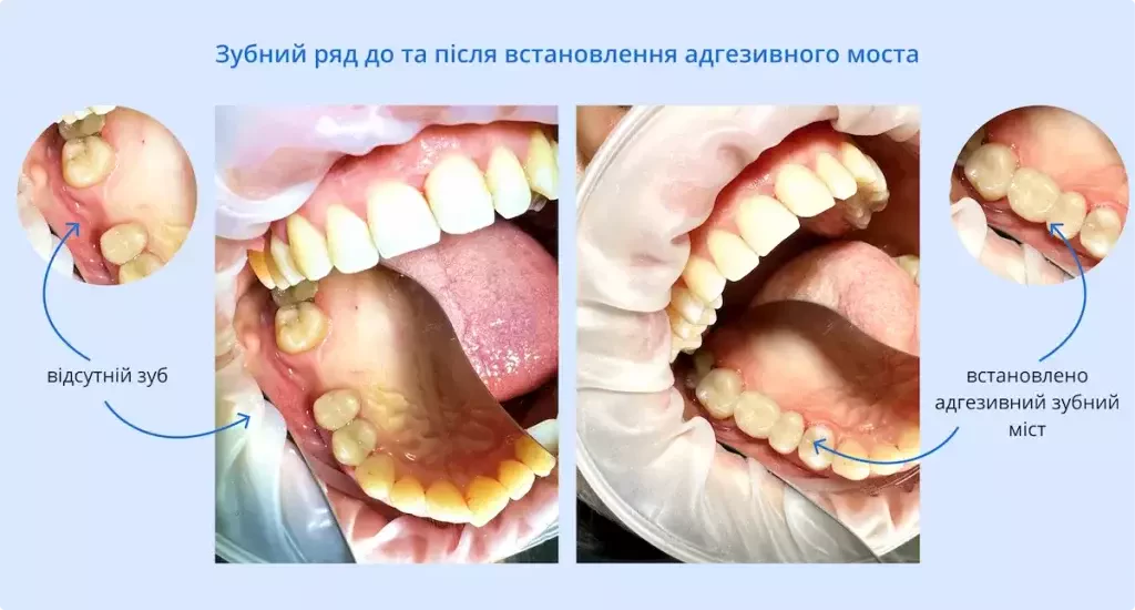 Адгезивний міст для відновлення зубного ряду | Терапія | Стоматологія D.Ante