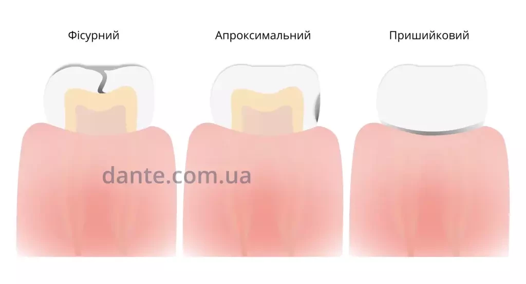 Види карієсу за локалізацією на зубі