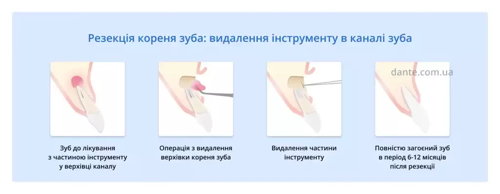 резекція кореня зуба для видалення інструменту в каналі зуба