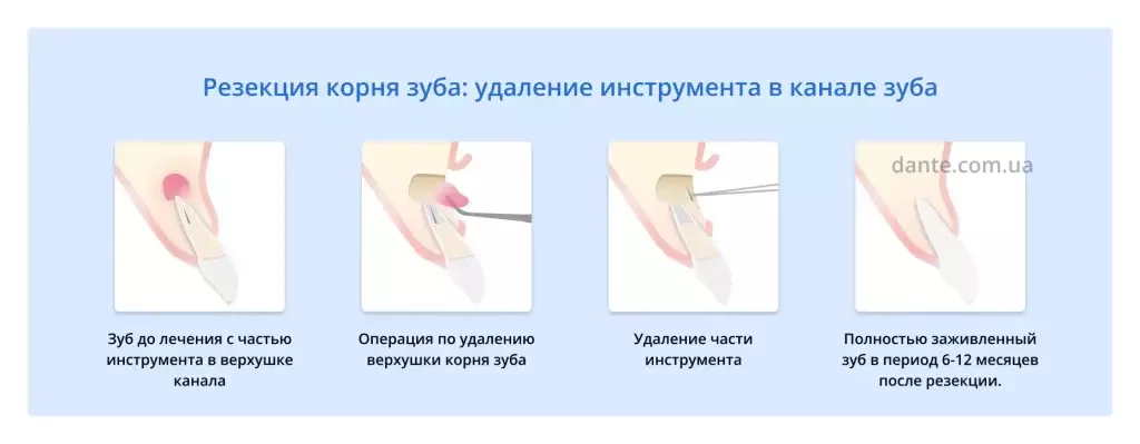 Резекция корня зуба при удалении инструмента из канала зуба