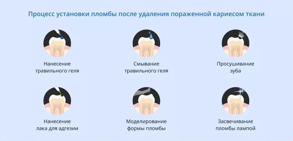 Установка пломбы после удаления пораженной кариесом ткани | Терапия | Стоматология D.Ante