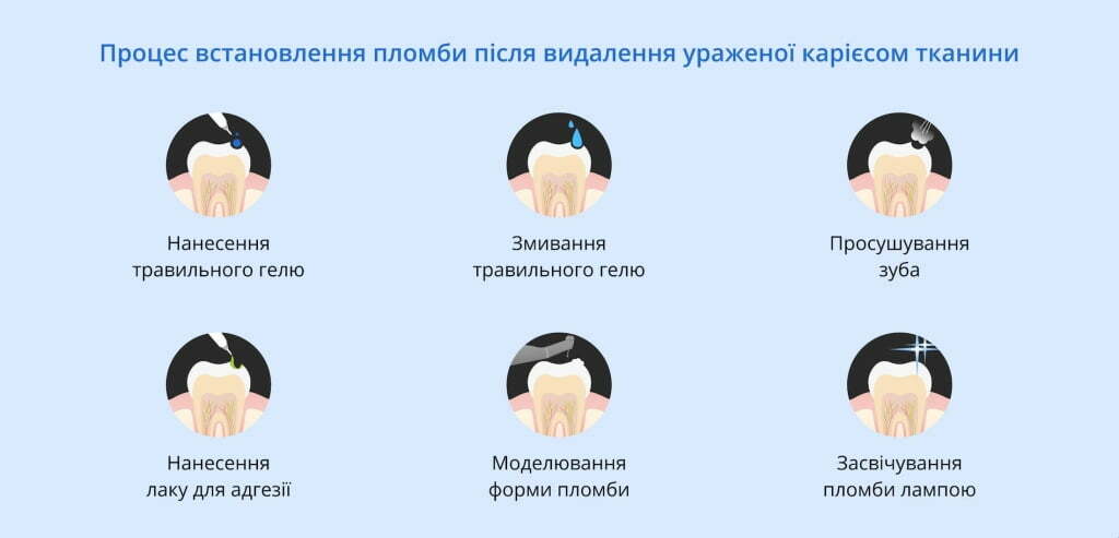 Встановлення пломби після видалення ураженої карієсом тканини | Терапія | Стоматологія D.Ante