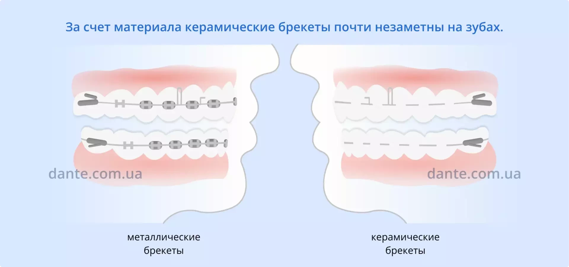 Керамические и металлические брекеты разница | Ортодонтия | Стоматология D.Ante