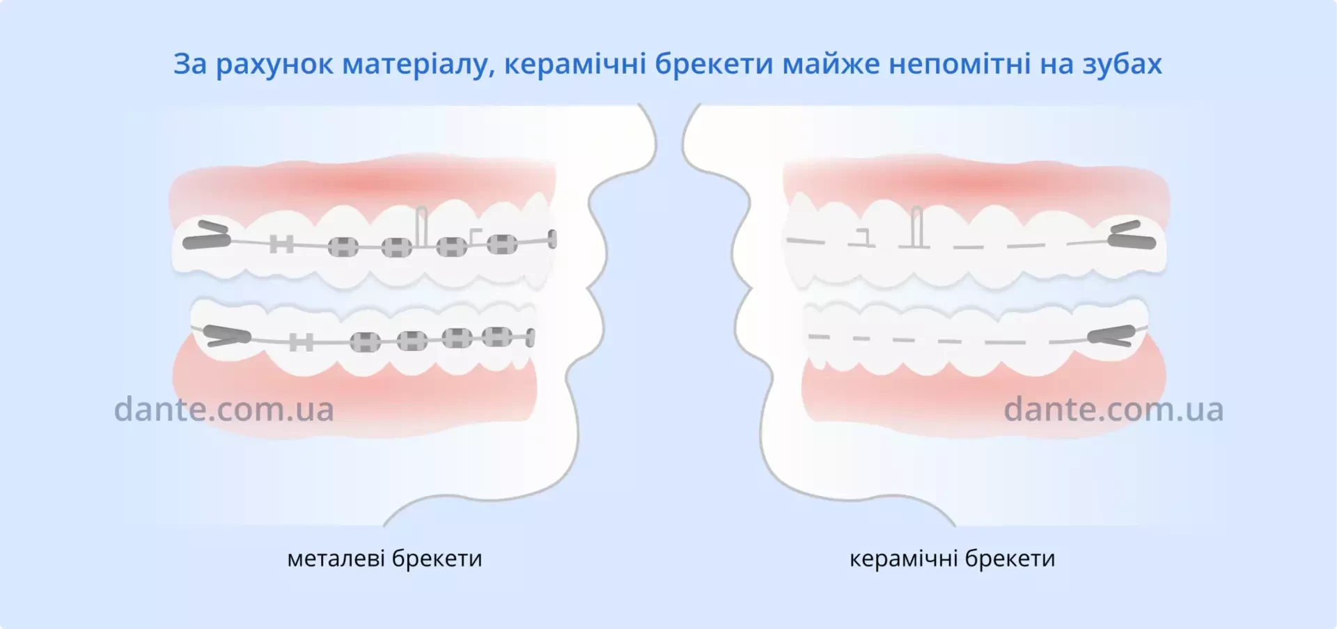 Керамічні та металеві брекети різниця | Ортодонтія | Стоматологія D.Ante