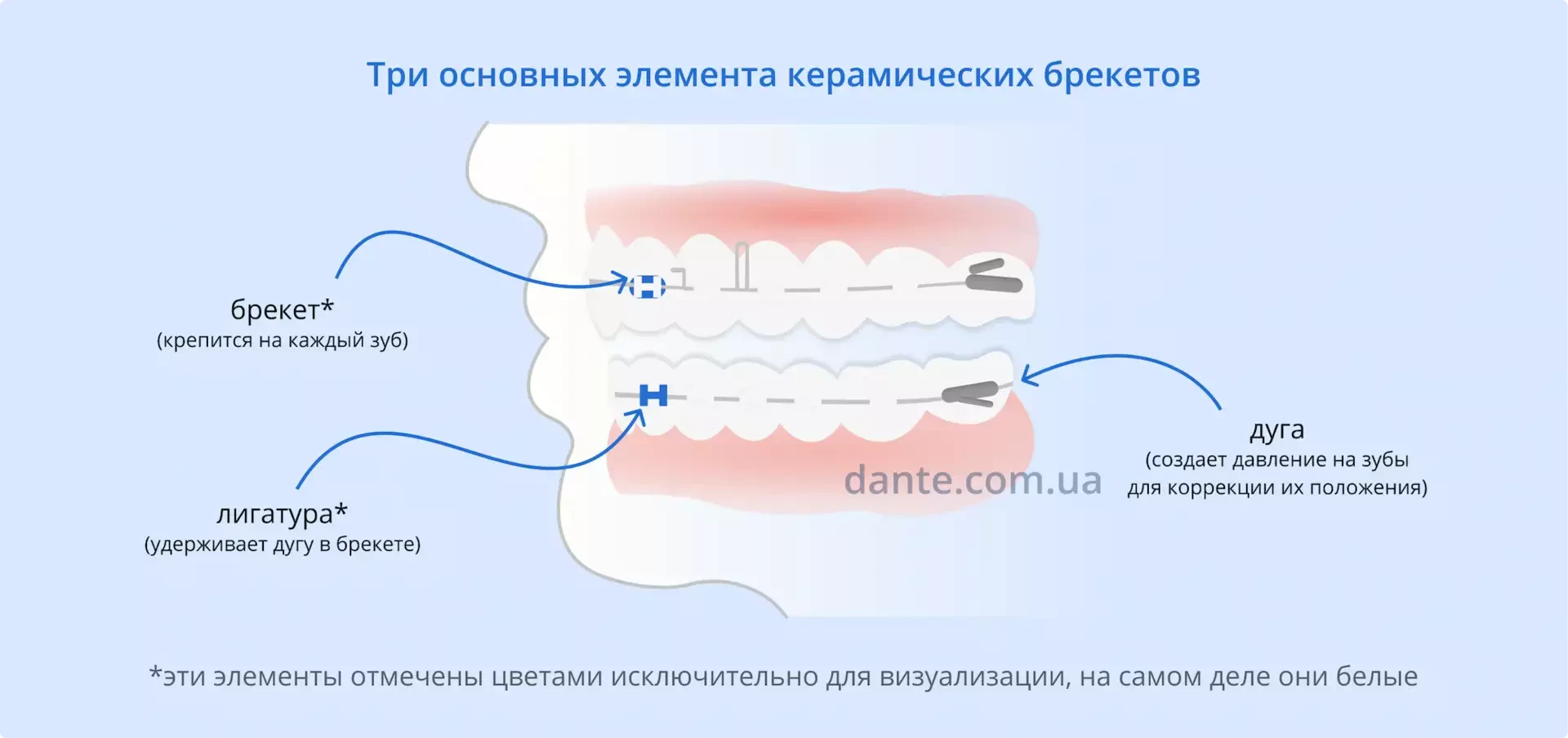 Из чего состоят керамические брекеты | Ортодонтия | Стоматология D.Ante