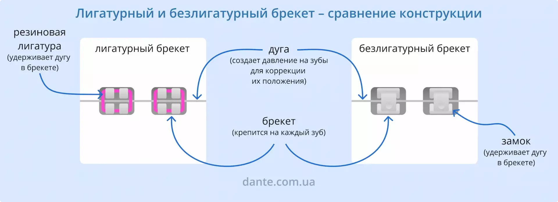 Лигатурный и безлигатурный брекет — сравнение конструкции | Ортодонтия | Стоматология D.Ante